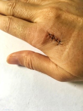 suture removal