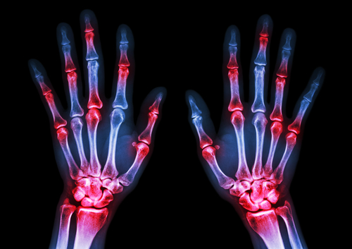osteoartritis en los dedos