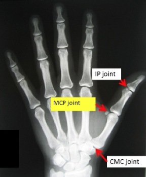 sesamoid bone hand