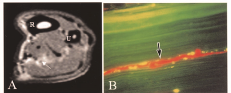 intraneural edema