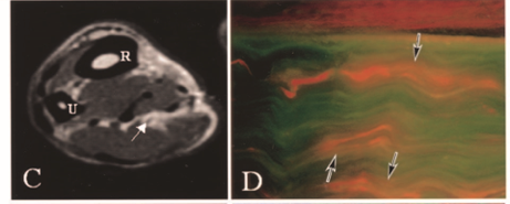 intraneural edema