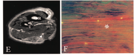 intraneural edema