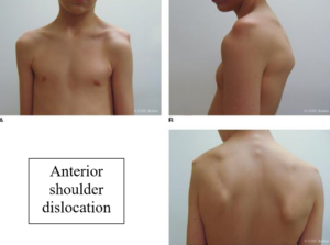 anterior shoulder instability