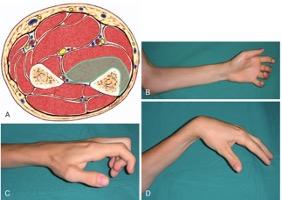 volkmann's contracture