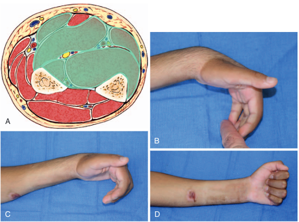 volkmann's contracture