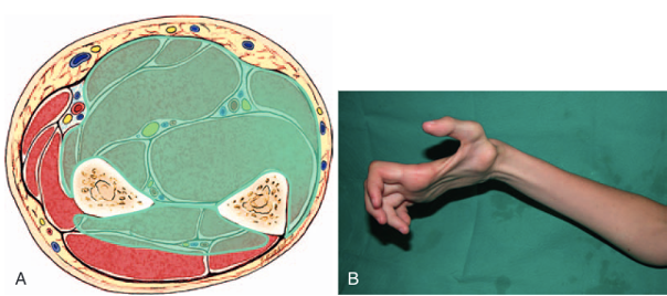 volkmann's contracture