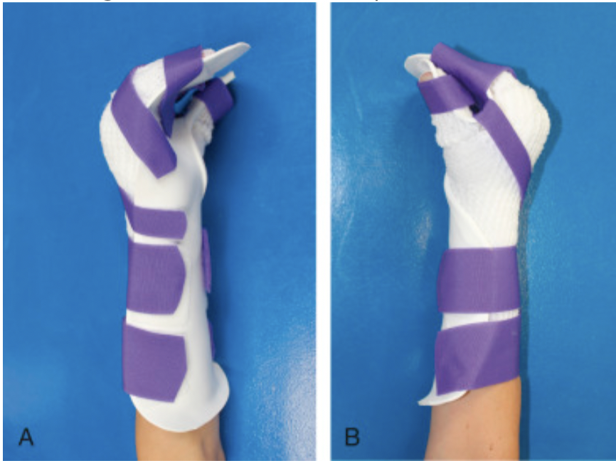 palmar extension splint