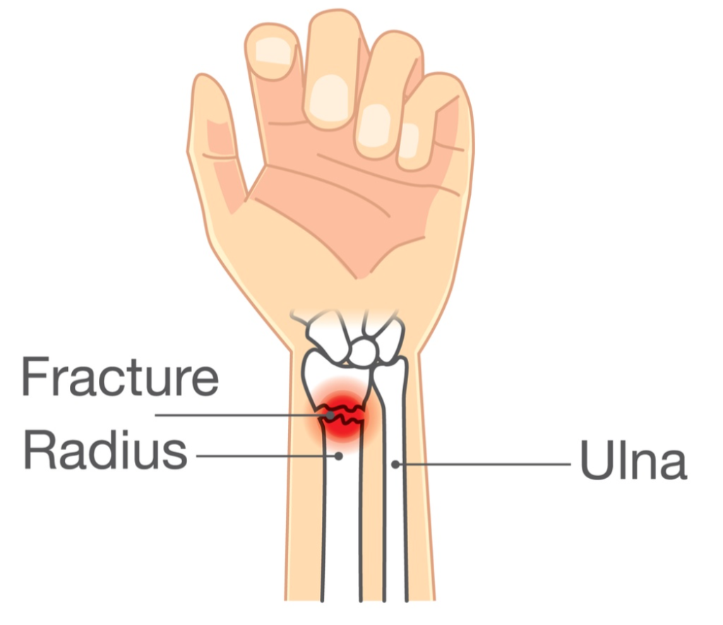 distal radius fracture home exercise program