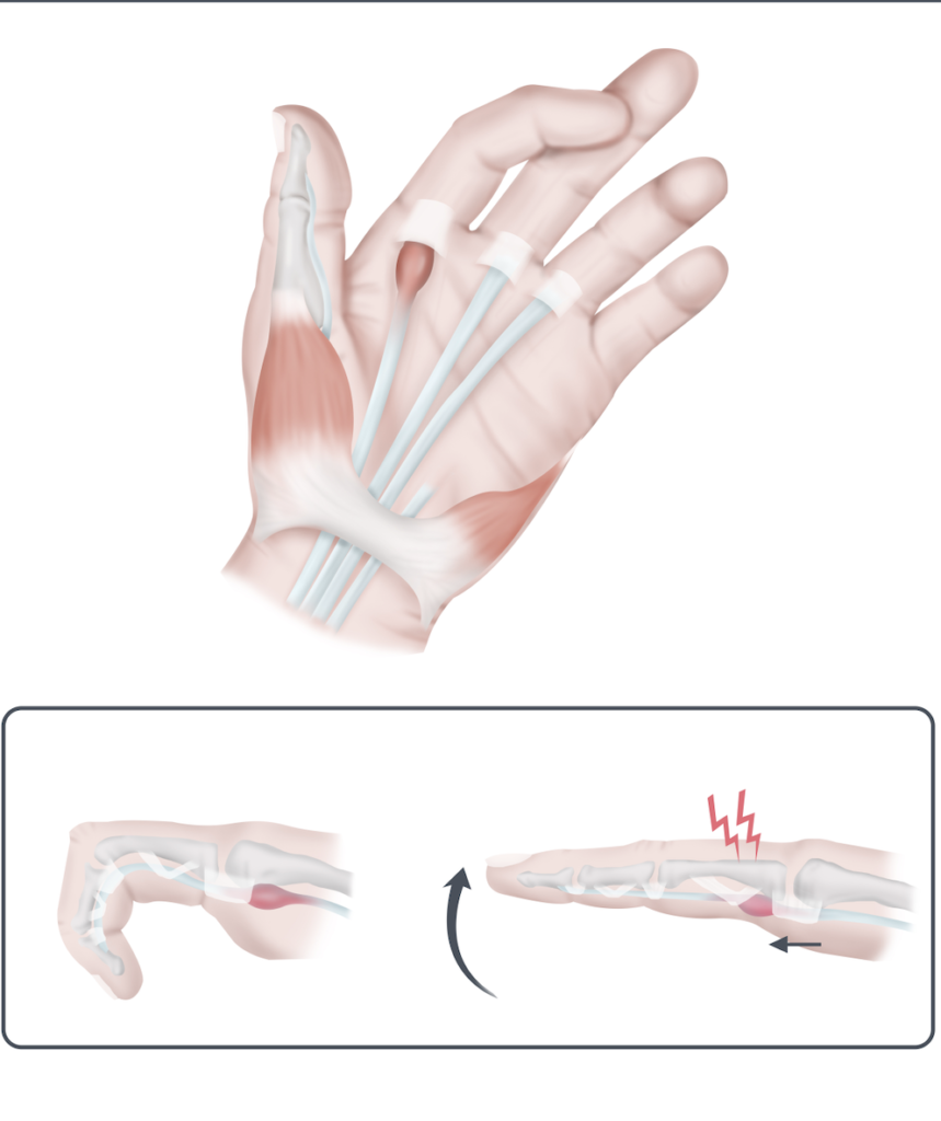 bruising after carpal tunnel surgery