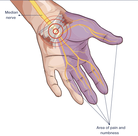 bruising after carpal tunnel surgery