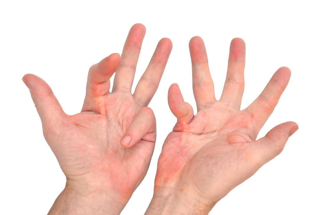 dupuytren's contracture exercises