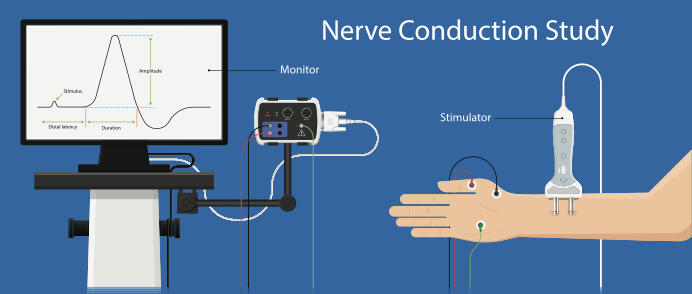Diferencia entre EMG y NCV