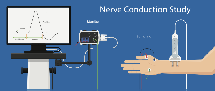 Difference between EMG and NCV