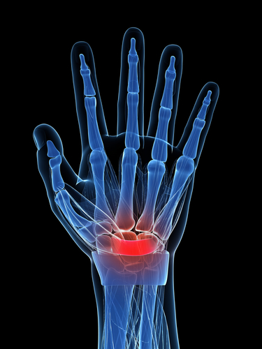 Handtherapie bei Karpaltunnel