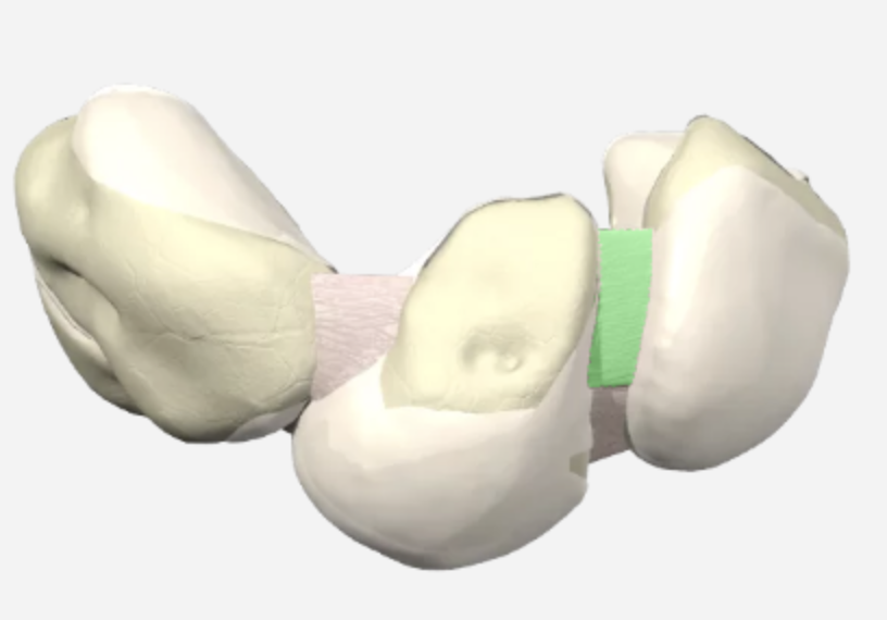 scapholunate instability exercises