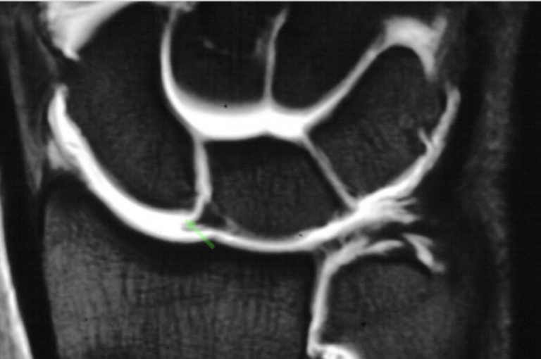 Scapholunate instability exercises | Hand Therapy Academy