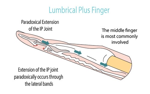 Flexor Tendon Treatment