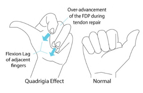 Flexor Tendon Treatment