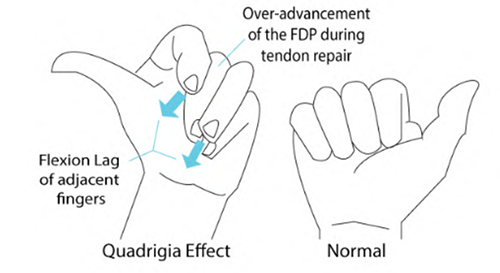 Tratamiento del tendón flexor