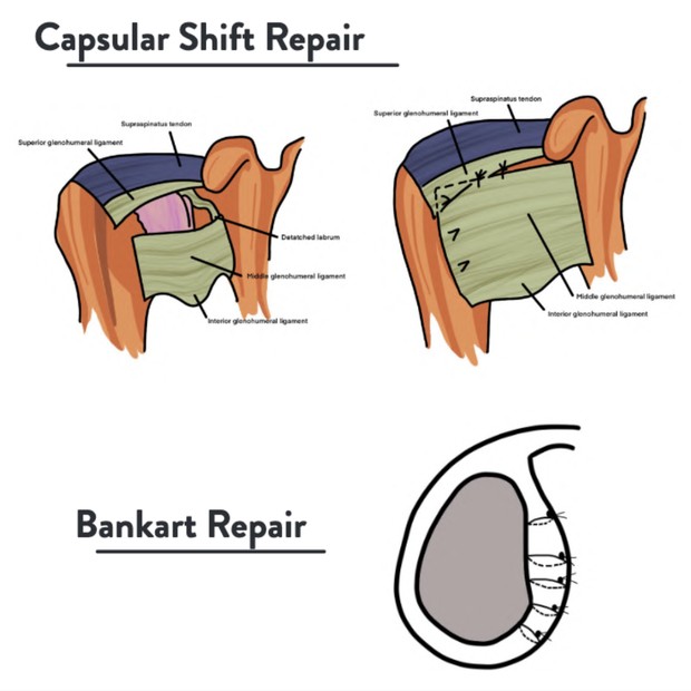 Shoulder Pain Rehab