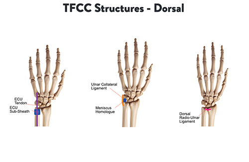 Ulnar Sided Wrist Pain