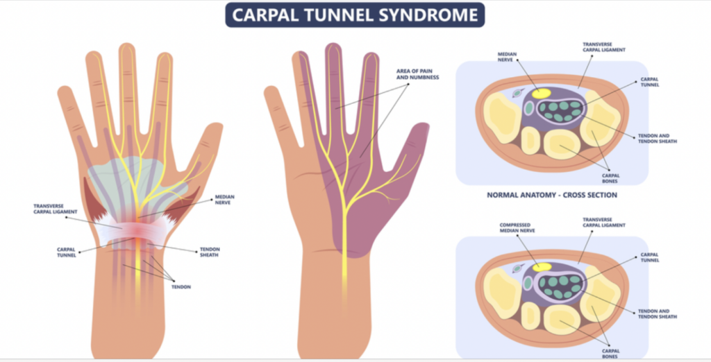 tunel carpal