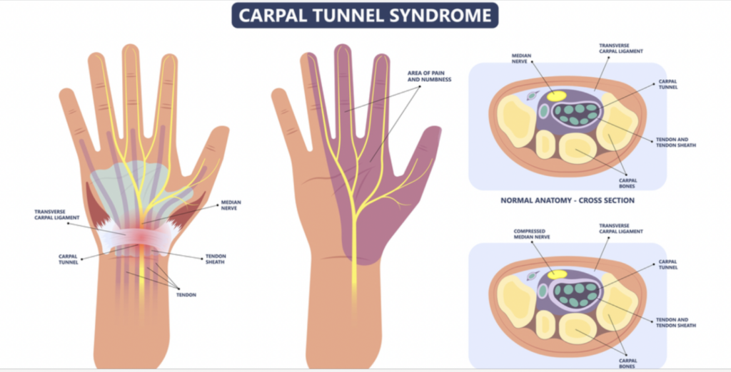 carpal tunnel