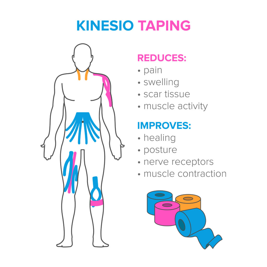 All about kinesiology taping!