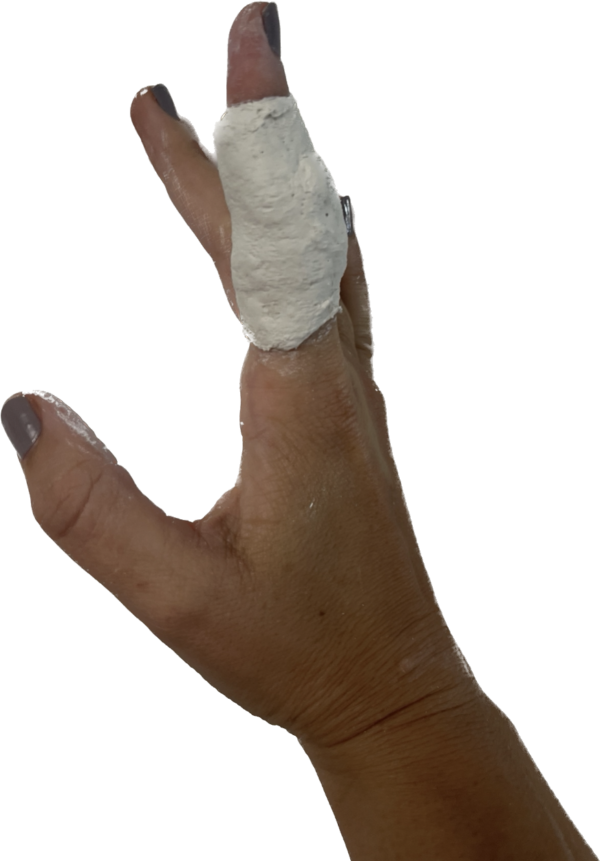 What are the splinting options for stiff finger joints?