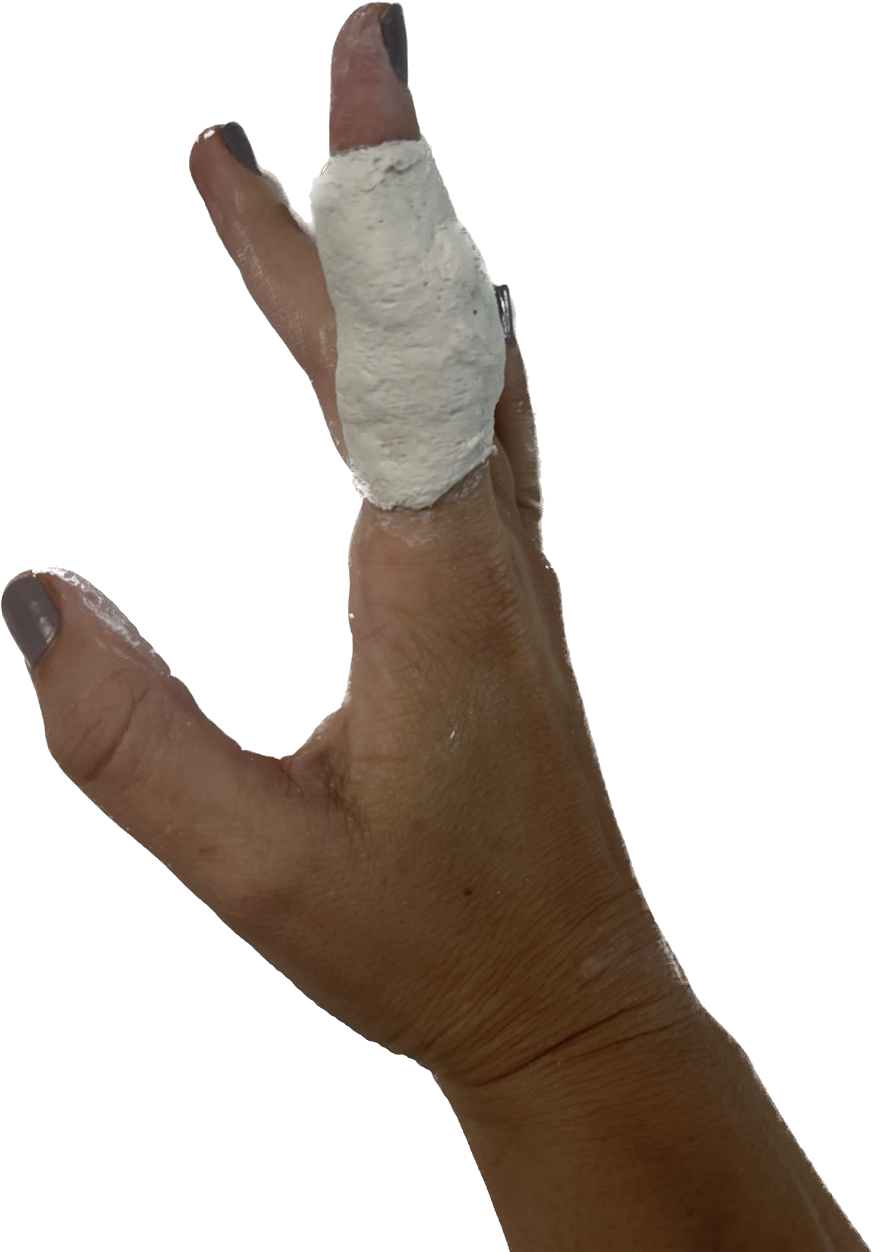 What are the splinting options for stiff finger joints?