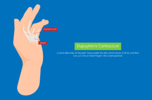 dupuytren's contracture