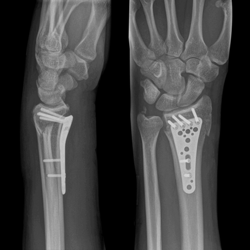 distal radius fracture
