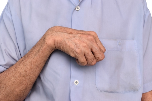 hand spasticity