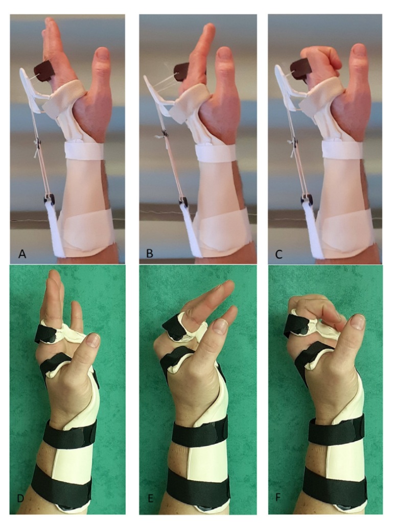extensor tendon