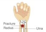 distal-radius-fracure