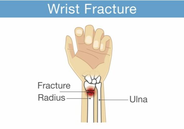 distal-radius-fracure