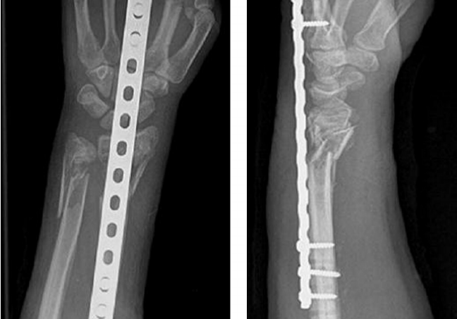 dorsal spanning plate