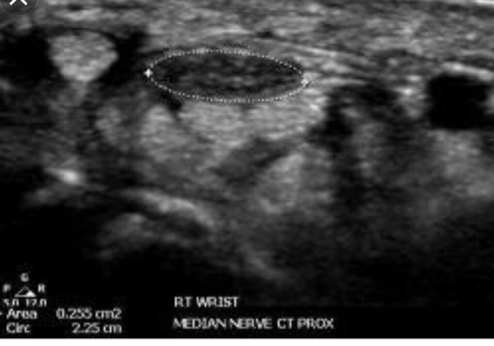 median nerve image