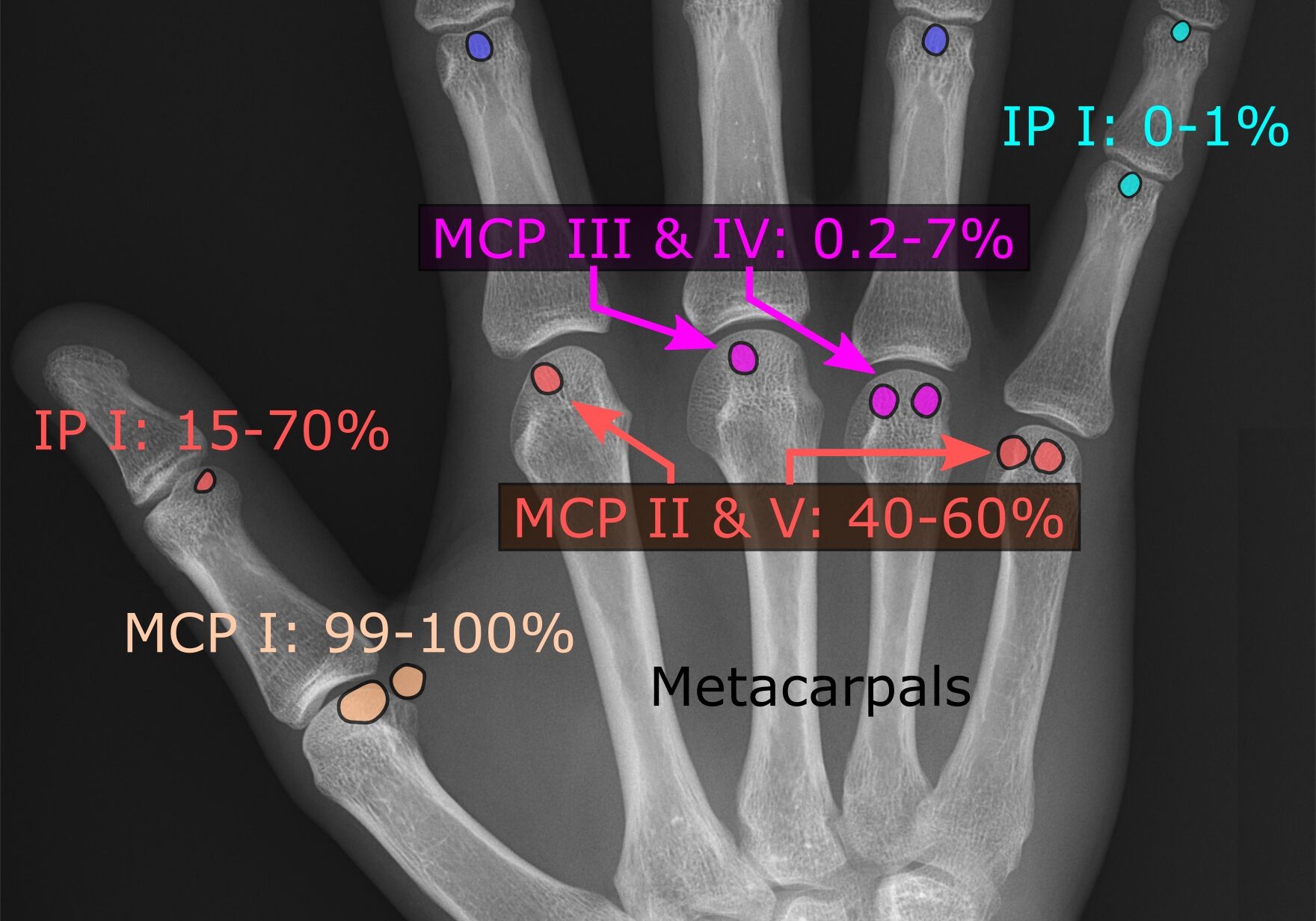 Sesambeinhand 2