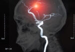 IRM,de,le,sang,vaisseaux,dans,le,cerveau,et,vasculaires
