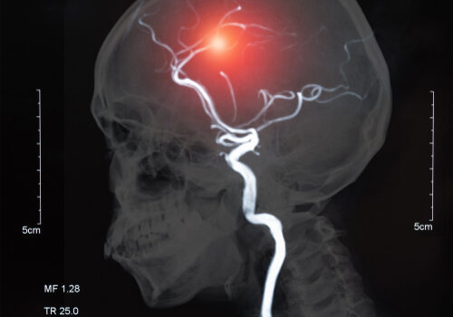 Mri,Of,The,Blood,Vessels,In,The,Brain,And,Cerebrovascular