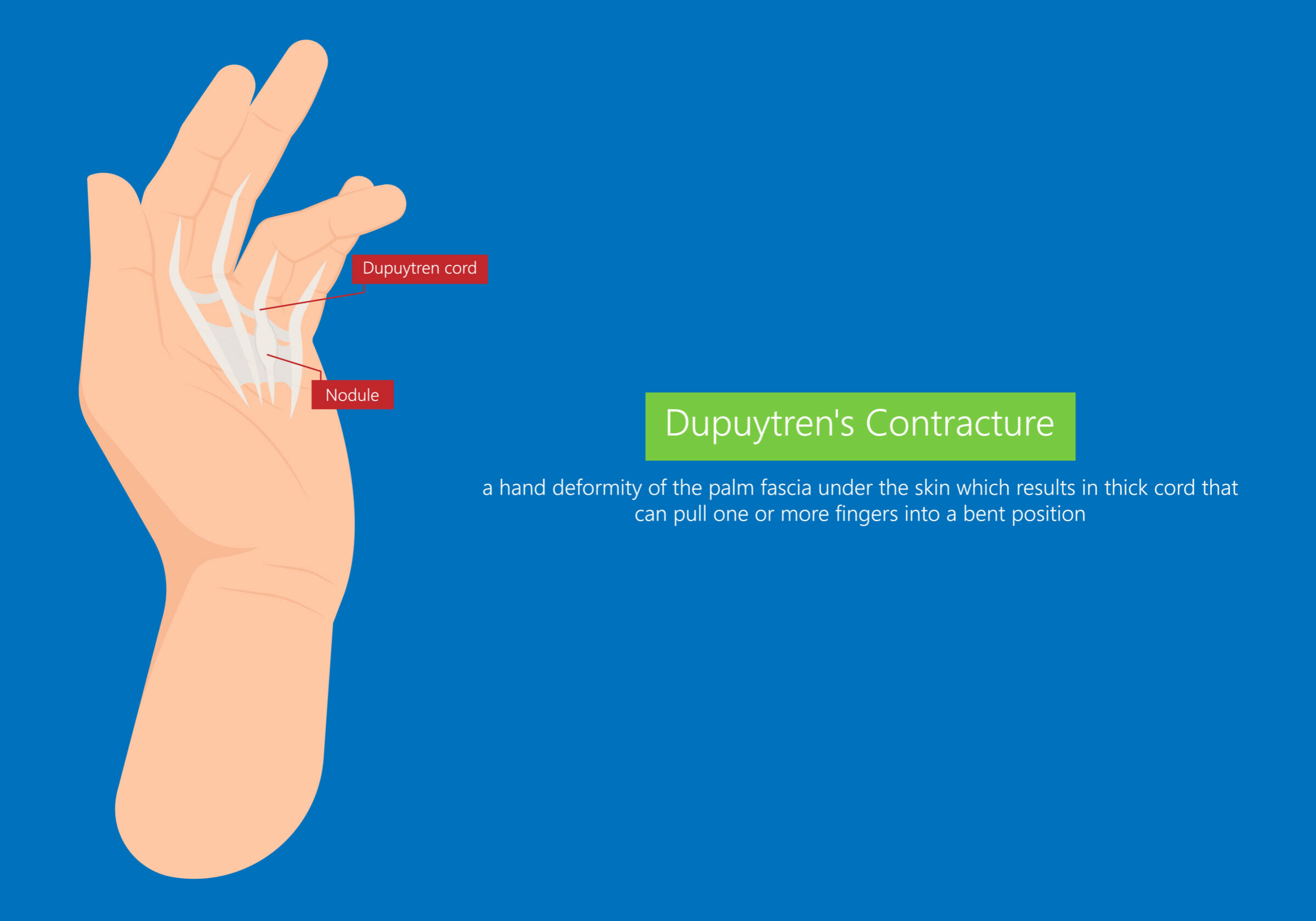 Dupuytren, contractura, palma, tejido, enfermedad