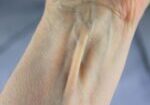 Muscle long palmaire, tendon visible situé entre le muscle fléchisseur du carpe