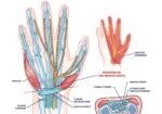 Carpal,Tunnel,Syndrome,With,Median,Nerve,Pressure,Disease,Outline,Diagram.