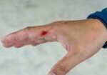 Dog,Bite,Wound,And,Blood,On,Hand.,Infection,And,Rabies