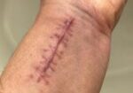 Keloid,Scar,On,Caucasion,Wrist