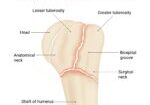 Diagram,Of,Proximal,Humerus,Fracture
