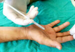 Steroid,Injection,To,Palmar,For,Treatment,Trigger,Finger