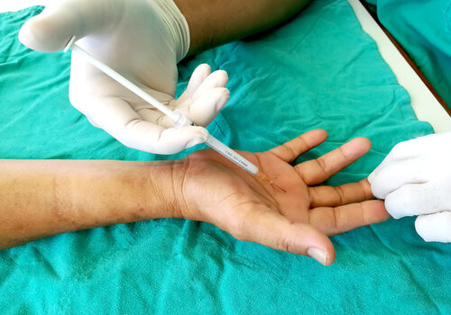 Steroid, Injektion, nach, Palmar, für, Behandlung, Auslöser, Finger