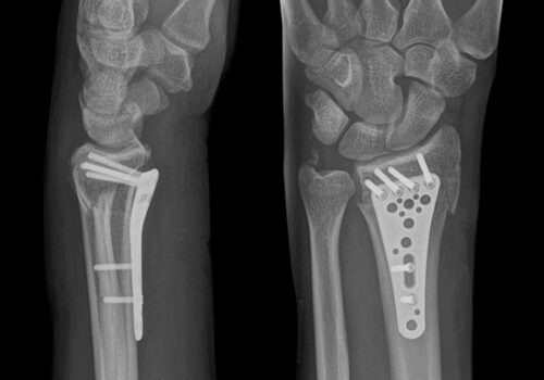 X-ray,Image,Of,Broken,Arm.,Distal,Radius,Fracture,Fixation,With